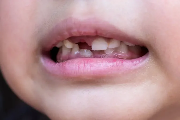 Is My Broken Tooth a Dental Emergency?