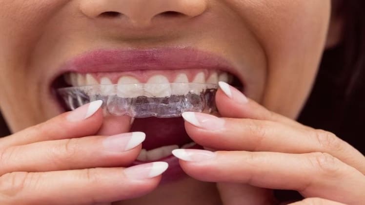 How Long Do You Need to Wear Invisalign Aligners?