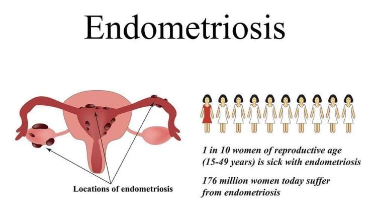 Managing Endometriosis Pain: Effective Treatment Approaches and Relief Strategies